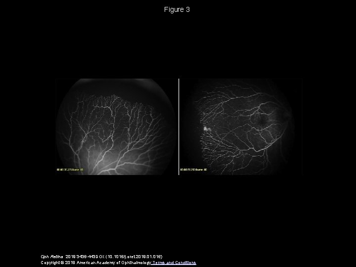 Figure 3 Oph Retina 2019 3436 -443 DOI: (10. 1016/j. oret. 2019. 016) Copyright