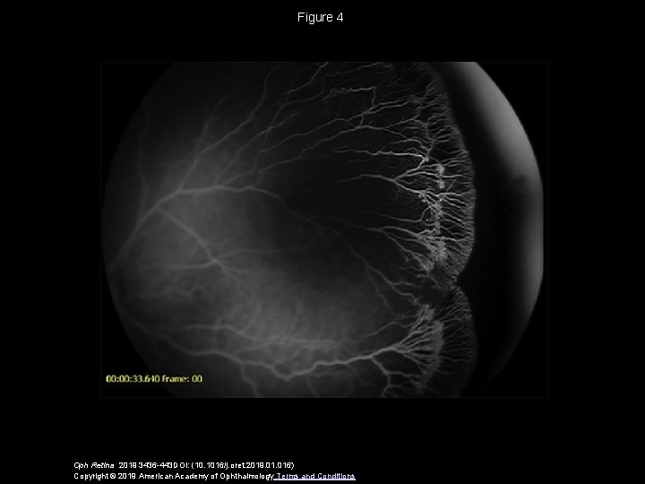 Figure 4 Oph Retina 2019 3436 -443 DOI: (10. 1016/j. oret. 2019. 016) Copyright