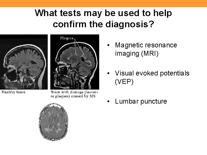 What tests may be used to help confirm the diagnosis? • Magnetic resonance imaging