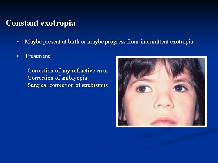 Strabismus Amblyopia Leukocoria Dr Hessah Alodan Pediatric Opthalmology