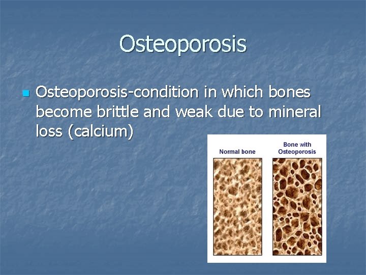 Osteoporosis n Osteoporosis-condition in which bones become brittle and weak due to mineral loss