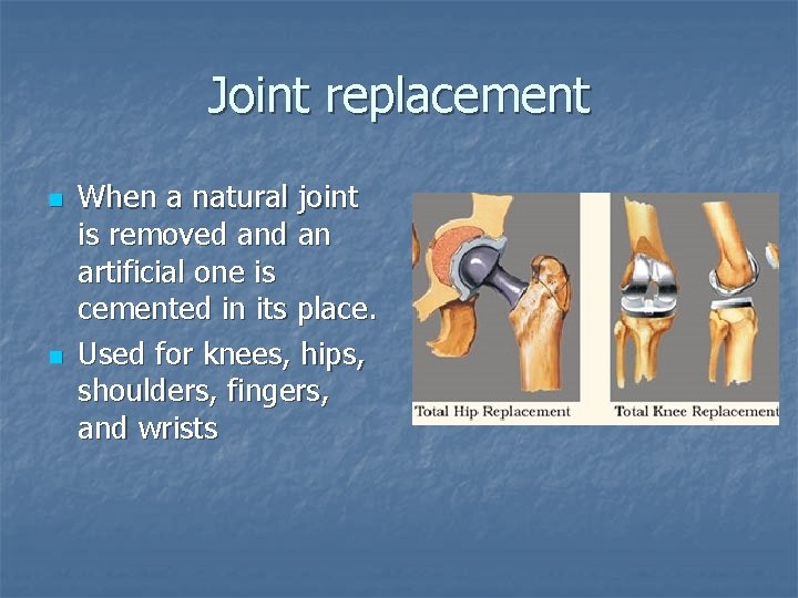 Joint replacement n n When a natural joint is removed an artificial one is