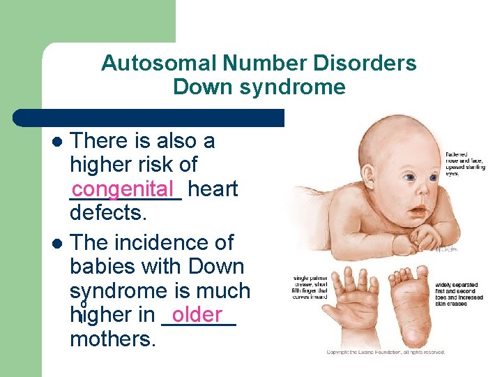 Autosomal Number Disorders Down syndrome There is also a higher risk of congenital _____