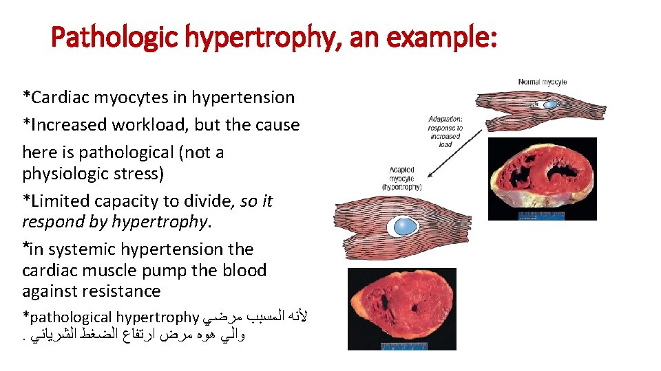 Pathologic hypertrophy, an example: *Cardiac myocytes in hypertension *Increased workload, but the cause here