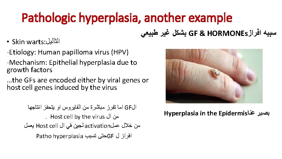 Pathologic hyperplasia, another example ﺑﺸﻜﻞ ﻏﻴﺮ ﻃﺒﻴﻌﻲ GF & HORMONEs ﺳﺒﺒﻪ ﺍﻓﺮﺍﺯ • Skin