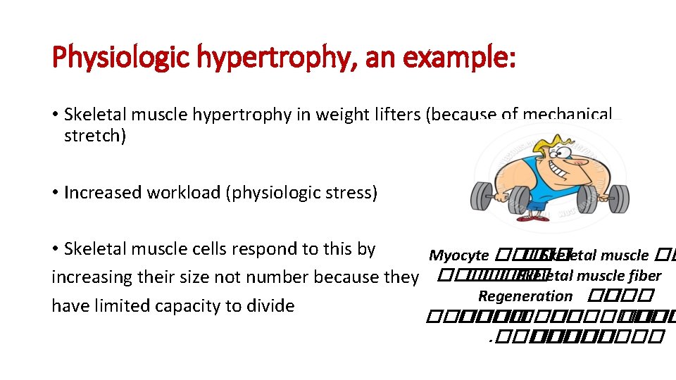 Physiologic hypertrophy, an example: • Skeletal muscle hypertrophy in weight lifters (because of mechanical