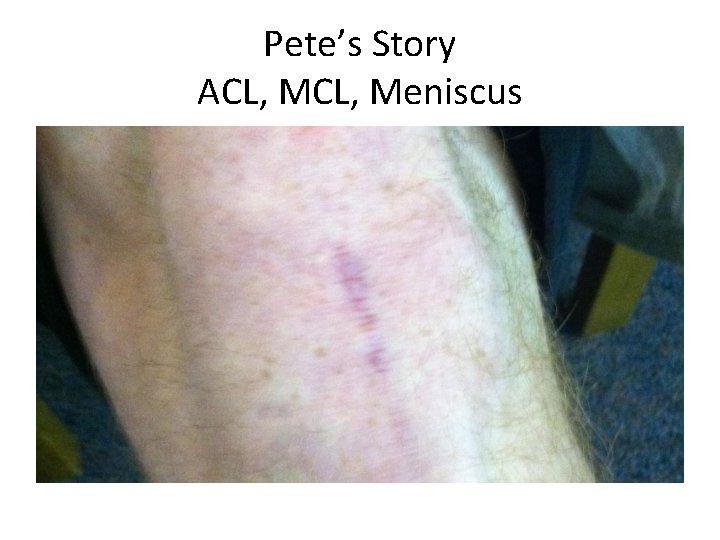 Pete’s Story ACL, Meniscus 