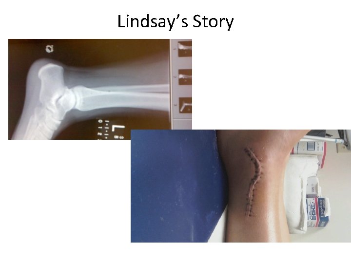 Lindsay’s Story 