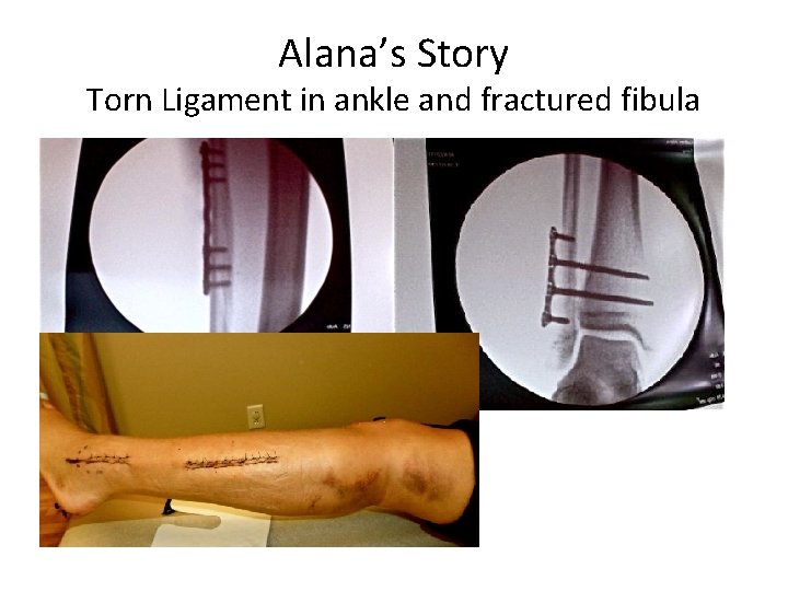 Alana’s Story Torn Ligament in ankle and fractured fibula 