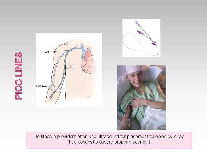 PICC LINES Healthcare providers often use ultrasound for placement followed by x-ray (fluoroscopy)to assure
