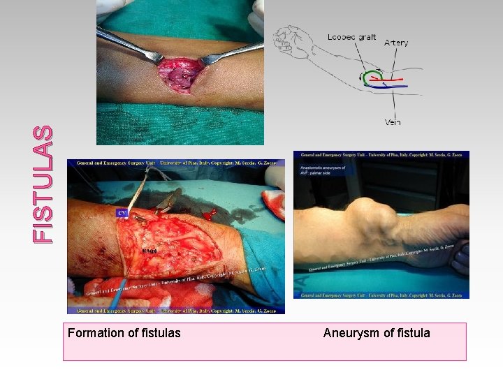 FISTULAS Formation of fistulas Aneurysm of fistula FISTULAS Formation of fistulas Aneurysm of fistula