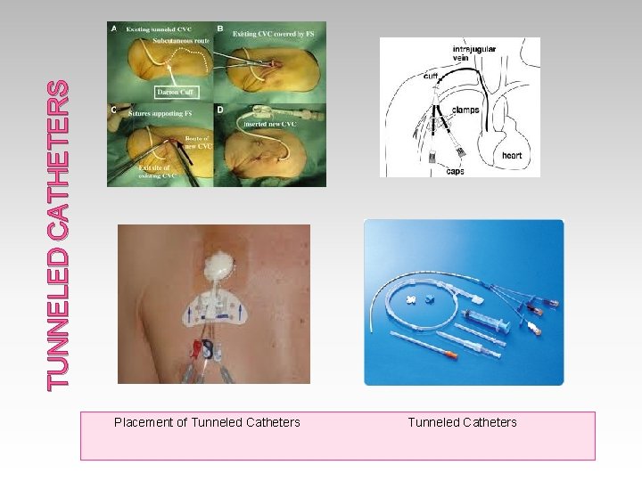TUNNELED CATHETERS Placement of Tunneled Catheters 
