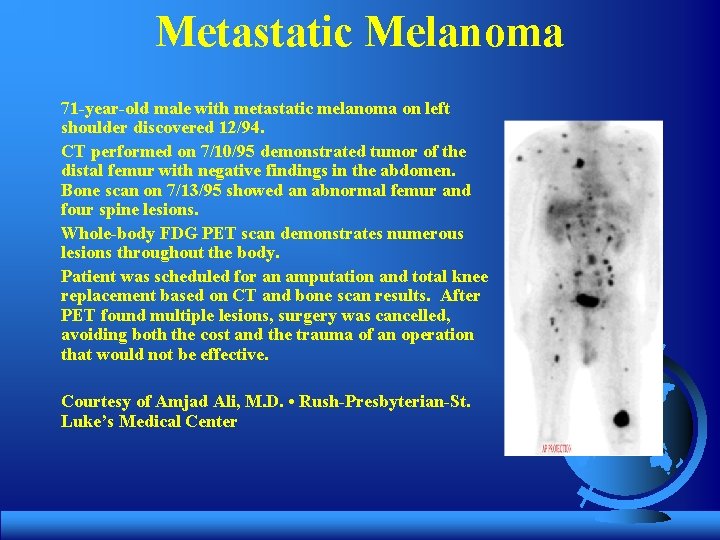 Metastatic Melanoma 71 -year-old male with metastatic melanoma on left shoulder discovered 12/94. CT