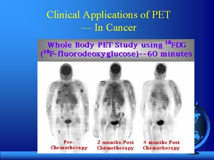 Clinical Applications of PET — In Cancer 