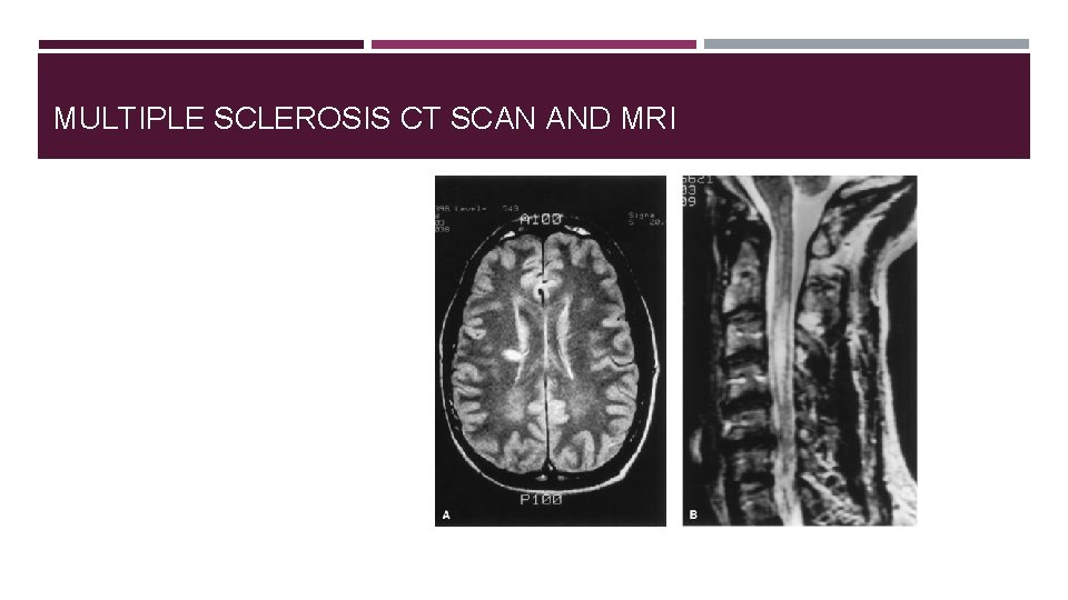 MULTIPLE SCLEROSIS CT SCAN AND MRI 