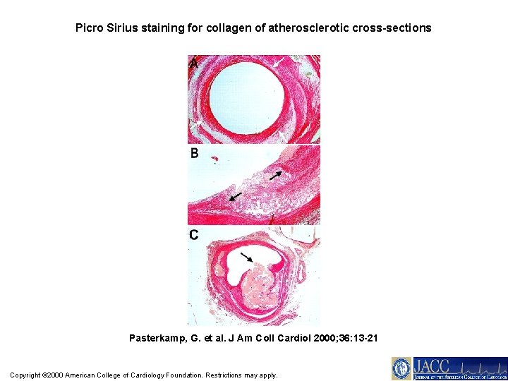 Picro Sirius staining for collagen of atherosclerotic cross-sections Pasterkamp, G. et al. J Am