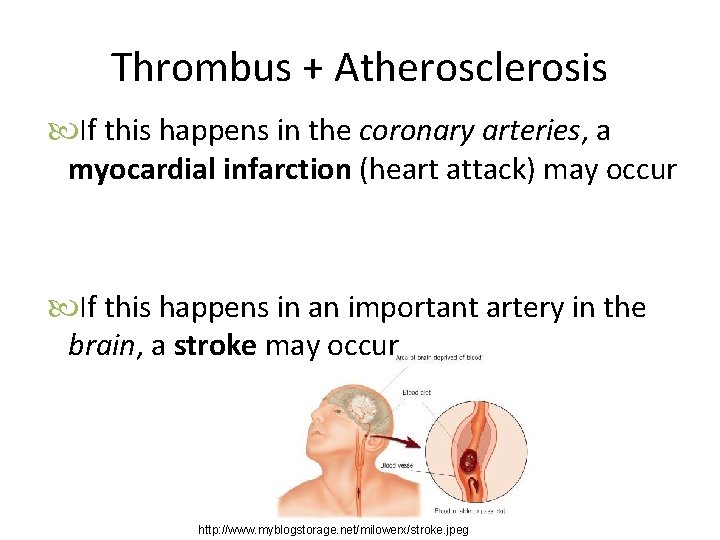 Thrombus + Atherosclerosis If this happens in the coronary arteries, a myocardial infarction (heart