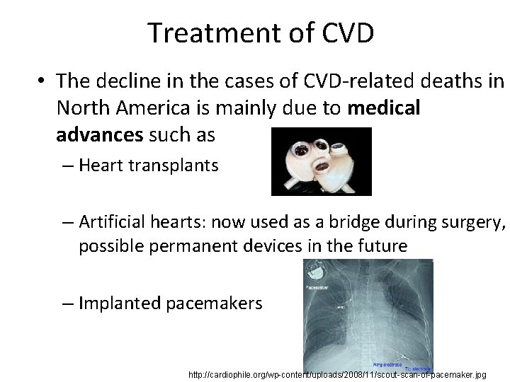 Treatment of CVD • The decline in the cases of CVD-related deaths in North