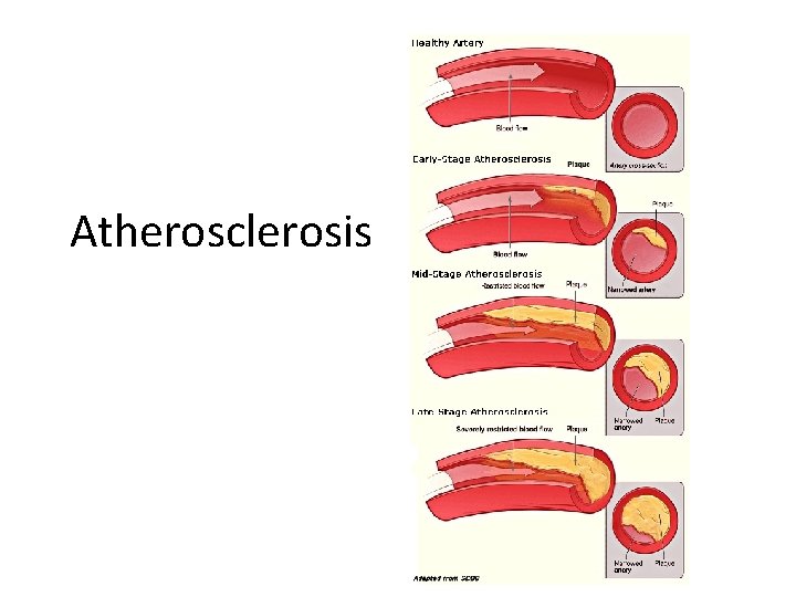 Atherosclerosis 