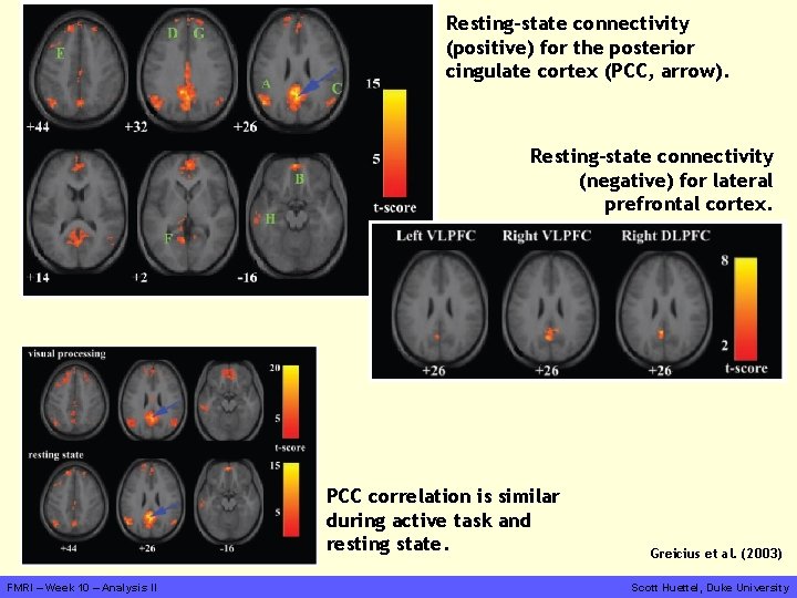 Resting-state connectivity (positive) for the posterior cingulate cortex (PCC, arrow). Resting-state connectivity (negative) for