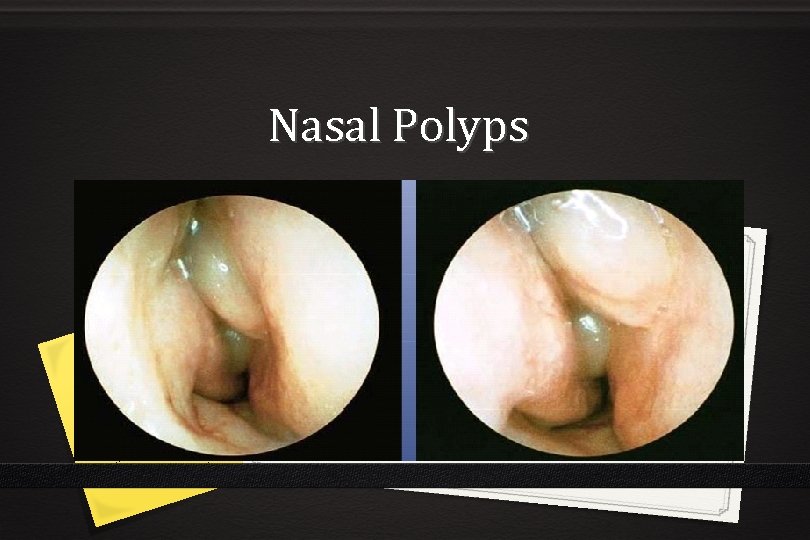 Nasal Polyps 