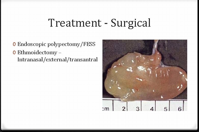 Treatment - Surgical 0 Endoscopic polypectomy/FESS 0 Ethmoidectomy – Intranasal/external/transantral Treatment - Surgical 0 Endoscopic polypectomy/FESS 0 Ethmoidectomy – Intranasal/external/transantral