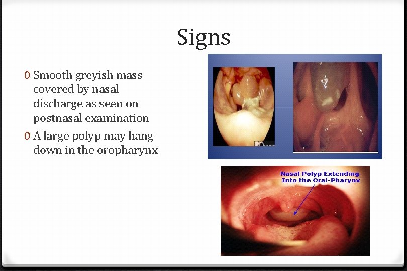 Signs 0 Smooth greyish mass covered by nasal discharge as seen on postnasal examination