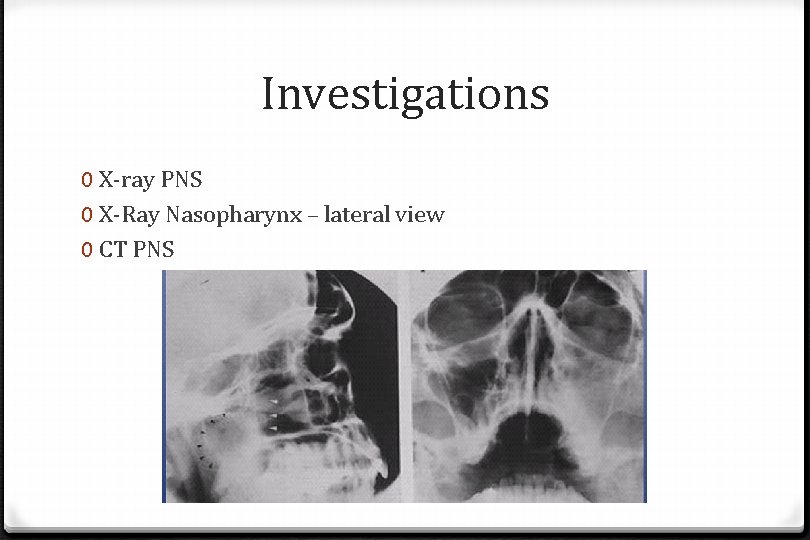 Investigations 0 X-ray PNS 0 X-Ray Nasopharynx – lateral view 0 CT PNS 