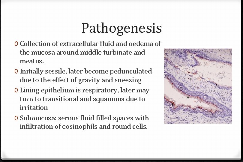 Pathogenesis 0 Collection of extracellular fluid and oedema of the mucosa around middle turbinate