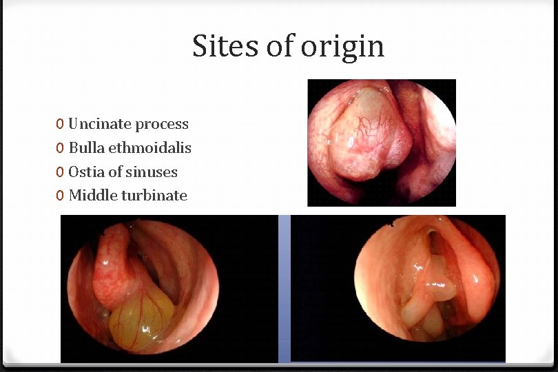 Sites of origin 0 Uncinate process 0 Bulla ethmoidalis 0 Ostia of sinuses 0