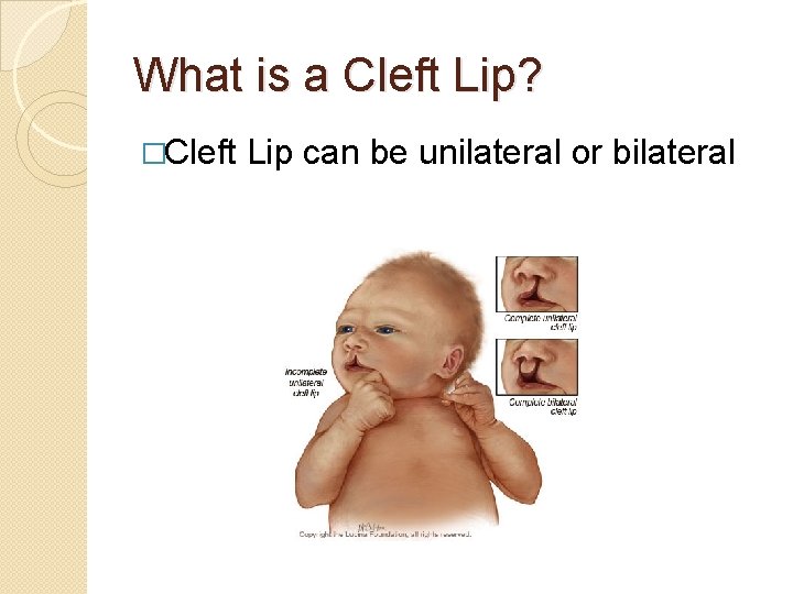 What is a Cleft Lip? �Cleft Lip can be unilateral or bilateral 