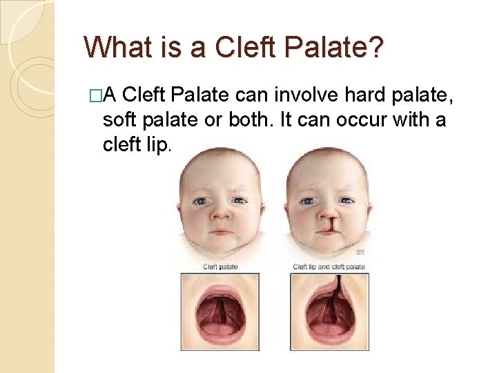 What is a Cleft Palate? �A Cleft Palate can involve hard palate, soft palate