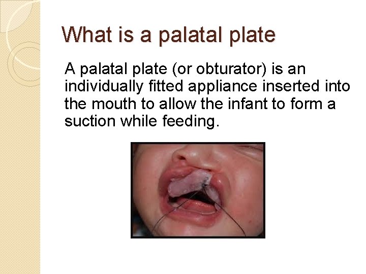 What is a palatal plate A palatal plate (or obturator) is an individually fitted