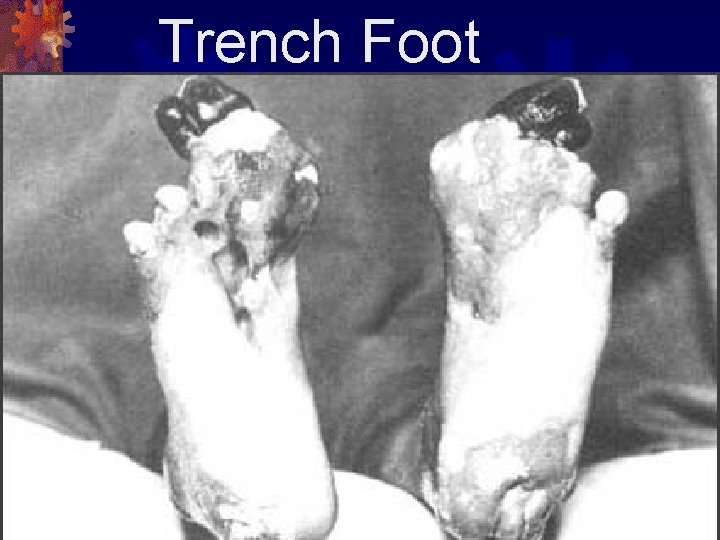 Trench Foot 