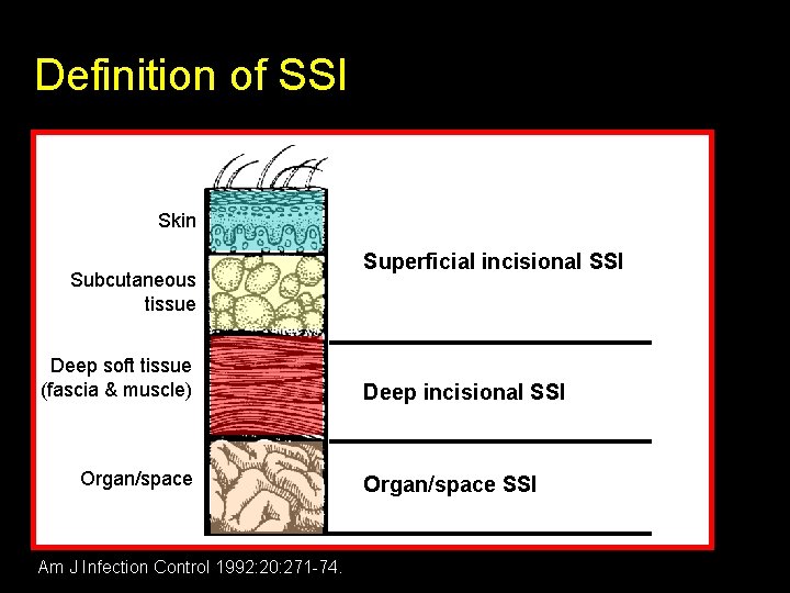 Surgical Site Infection PROF MAZIN ALHAWAZ Definition of