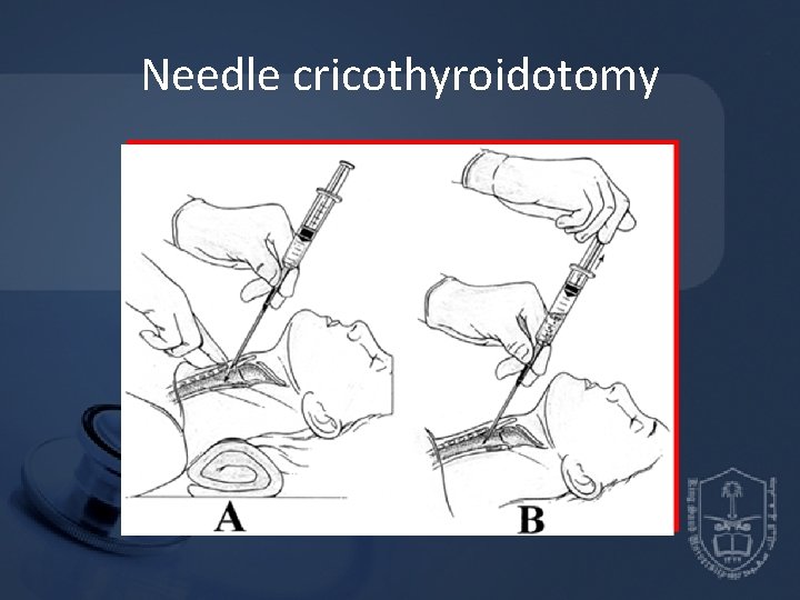 Needle cricothyroidotomy Needle cricothyroidotomy