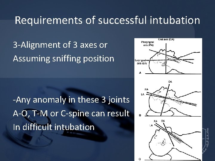 Requirements of successful intubation 3 -Alignment of 3 axes or Assuming sniffing position -Any Requirements of successful intubation 3 -Alignment of 3 axes or Assuming sniffing position -Any