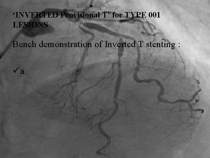‘INVERTED Provisional T’ for TYPE 001 LESIONS Bench demonstration of Inverted T stenting :
