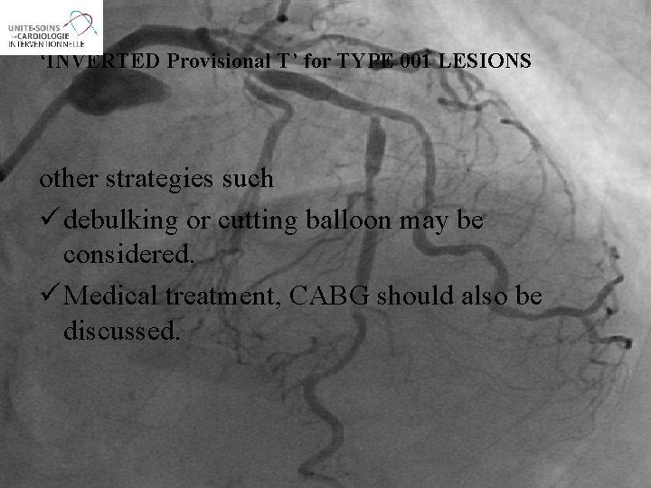 ‘INVERTED Provisional T’ for TYPE 001 LESIONS other strategies such ü debulking or cutting