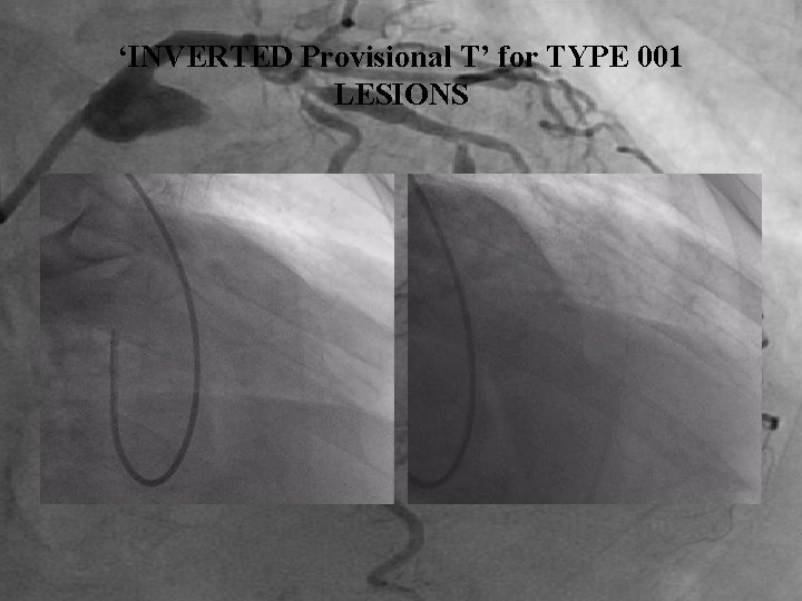 ‘INVERTED Provisional T’ for TYPE 001 LESIONS 