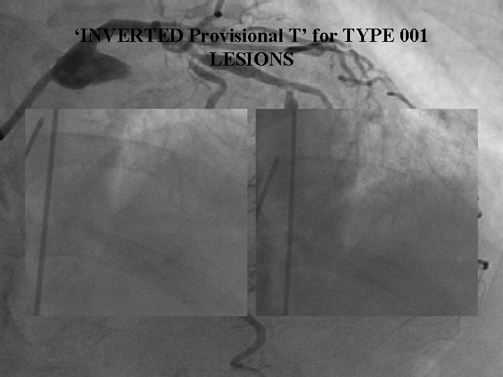 ‘INVERTED Provisional T’ for TYPE 001 LESIONS 
