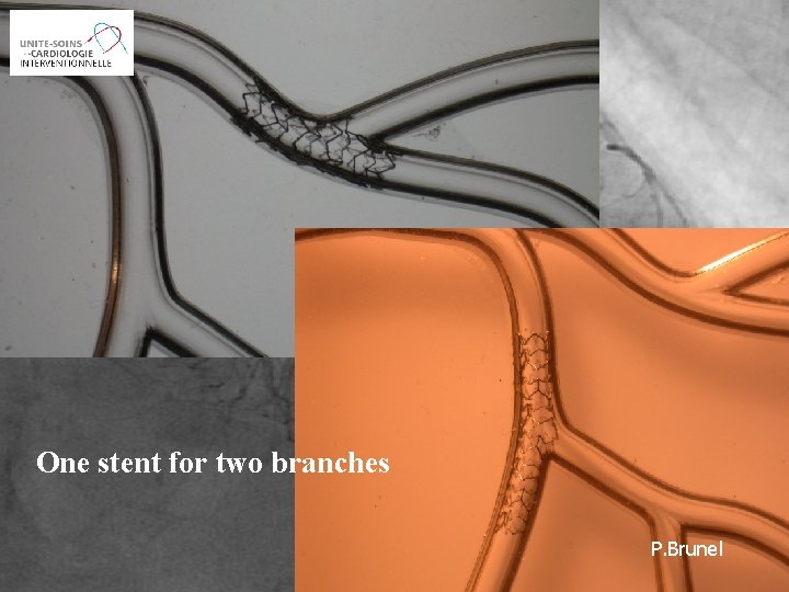 The SURF registry 21 ST Annual Interventional Cardiology 2006 P. Brunel One stent for