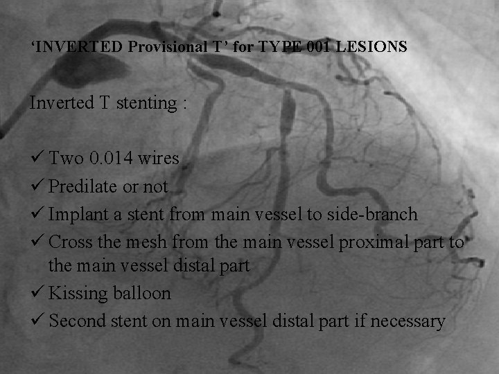‘INVERTED Provisional T’ for TYPE 001 LESIONS Inverted T stenting : ü Two 0.