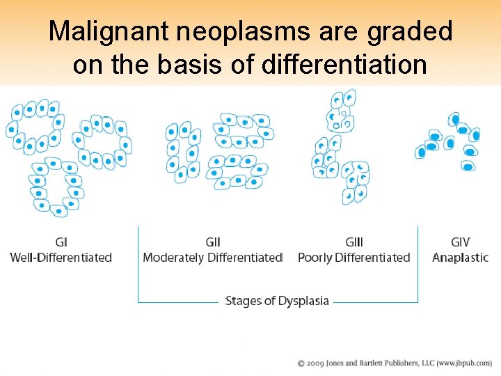 Malignant neoplasms are graded on the basis of differentiation 