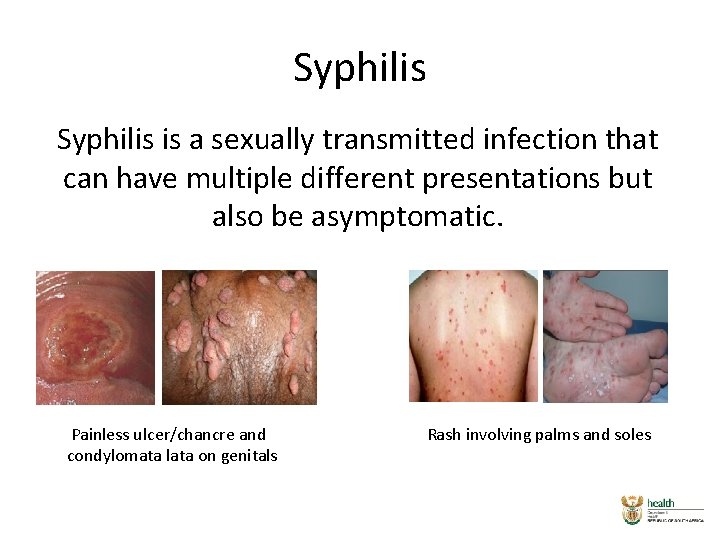 Syphilis is a sexually transmitted infection that can have multiple different presentations but also Syphilis is a sexually transmitted infection that can have multiple different presentations but also