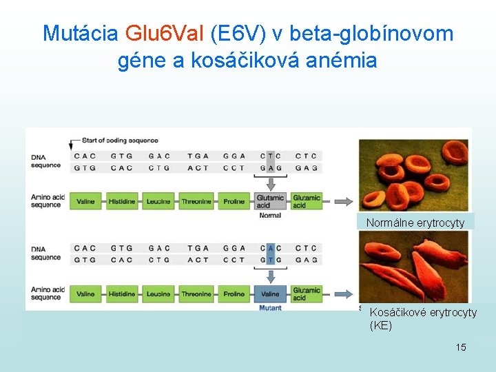 Mutácia Glu 6 Val (E 6 V) v beta-globínovom géne a kosáčiková anémia Normálne