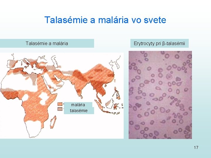 Talasémie a malária vo svete Talasémie a malária Erytrocyty pri β-talasémii malária talasémie 17