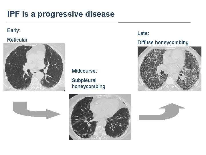 IPF is a progressive disease Early: Late: Reticular Diffuse honeycombing Midcourse: Subpleural honeycombing 