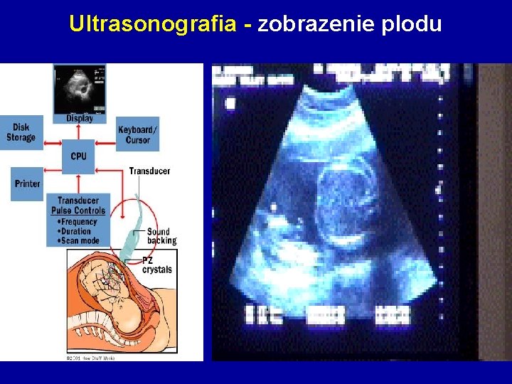 Ultrasonografia - zobrazenie plodu 