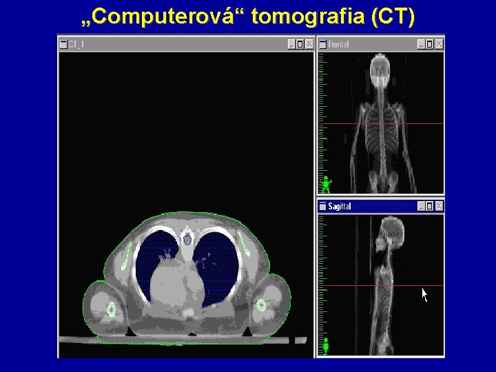„Computerová“ tomografia (CT) 